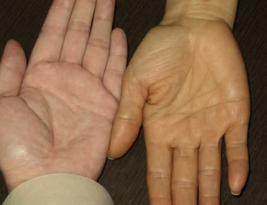 肝脏|为何肝癌越来越多?医生提醒:或是“3种食物”惹的祸,趁早撤下餐桌