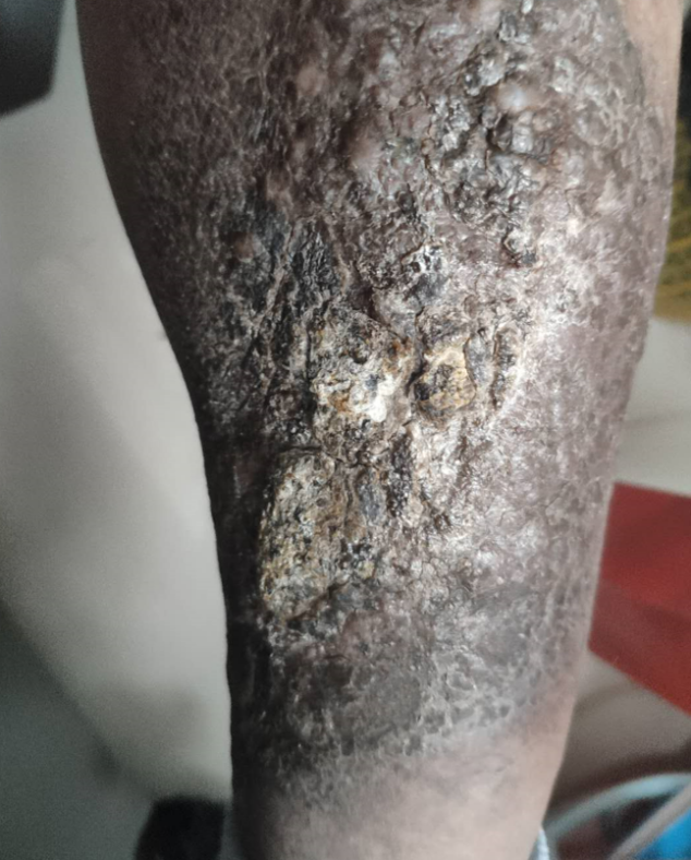 蜂蜜|【静脉溃疡案例6】72岁老大爷静脉溃疡怎么治疗？