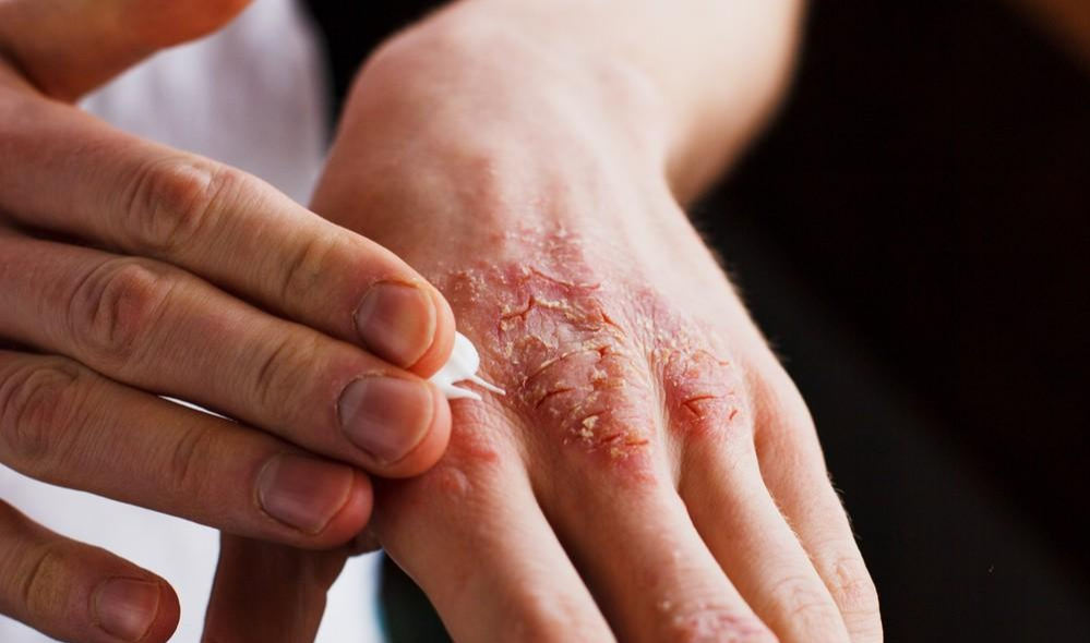 神经瘤|分享一味抗癌中药——萹蓄,利尿通淋、杀虫止痒,常用于乳腺癌