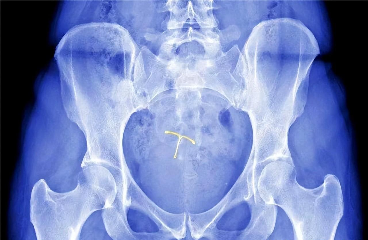 结扎|节育环一直不取出来,会长到肉里吗?在多大年龄之前取出比较好?