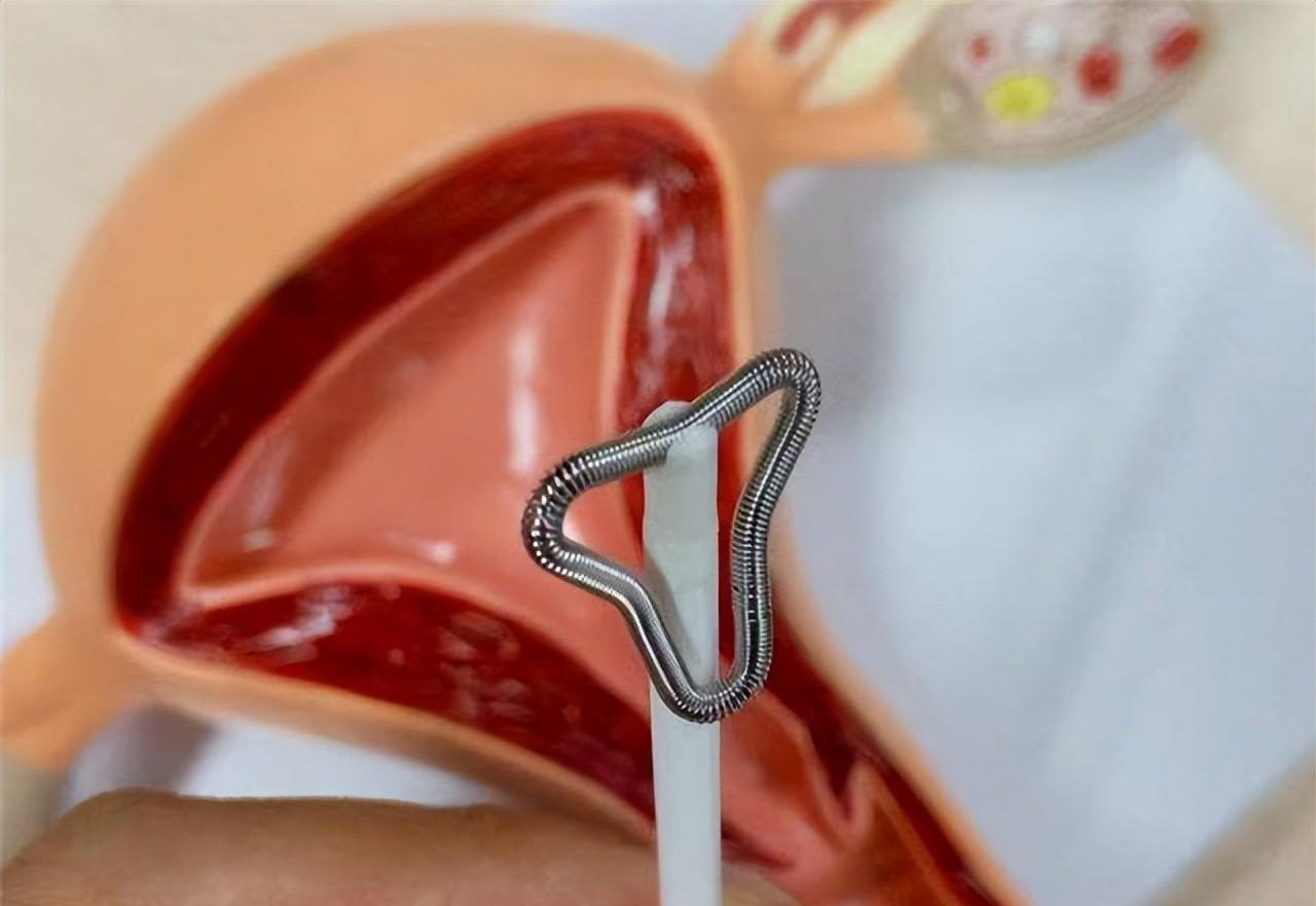 结扎|节育环一直不取出来,会长到肉里吗?在多大年龄之前取出比较好?