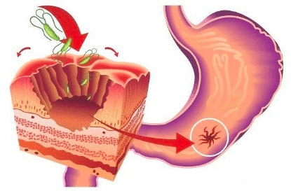 |世卫组织呼吁：停止食用3种蔬菜，再不忌口，小心胃烂如“破布”