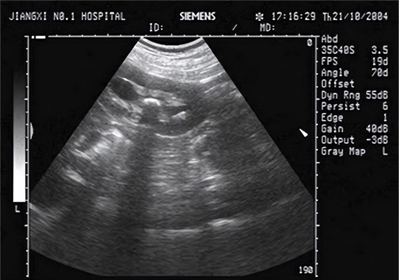 降压药|65岁老人常年吃氨氯地平,擅自换药肾衰竭!这些降压药知识需清楚