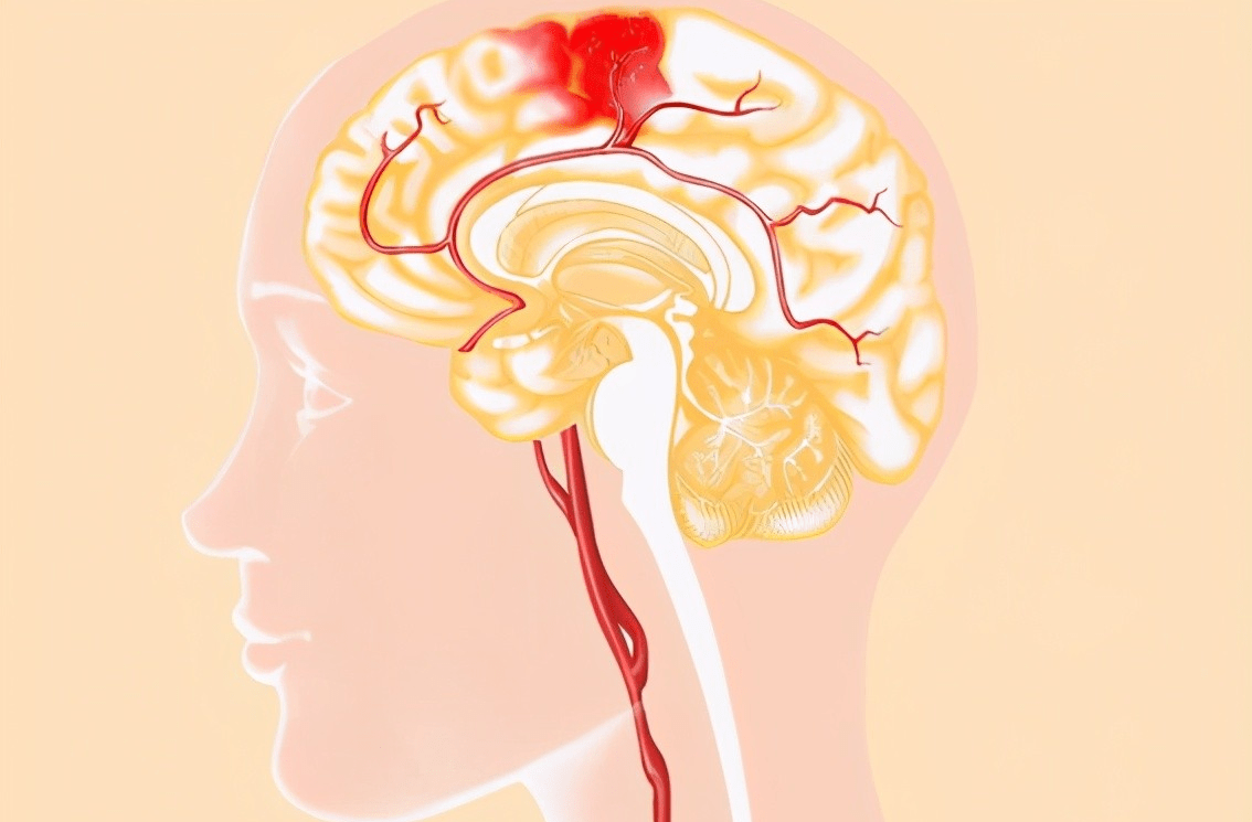 高血压|58岁大哥血压从161降至120,老年科医生:他的“3法”,值得借鉴