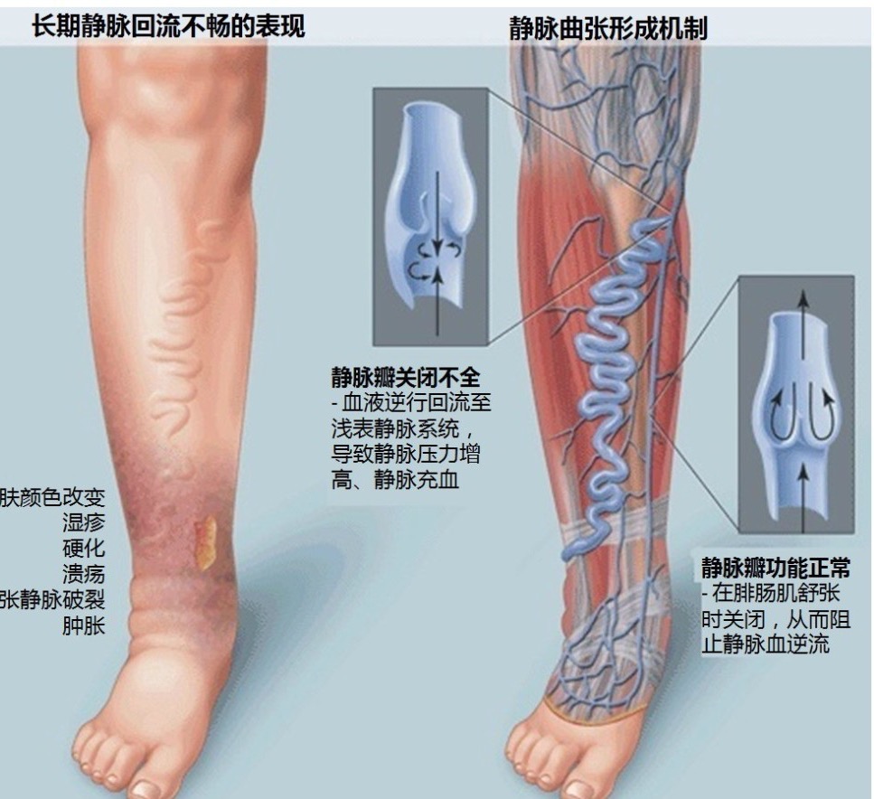 静脉曲张|斩不断，理还乱？恼人的下肢静脉曲张，手术后为何总复发？