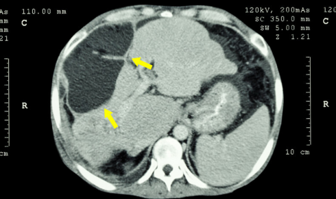老寒腿|21岁少女疑似怀孕，却查出肝癌，医生：“2水”再不戒，肝或“烂如渣”
