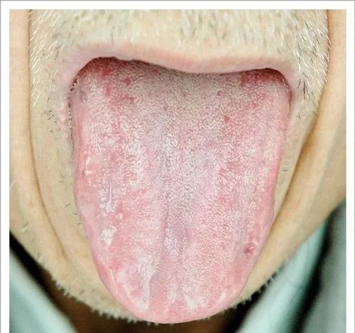 人均寿命|辨舌象,察病情,从四种舌象中找到“治癌”方法!