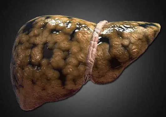 酒精肝|酒精肝检查项目有哪些?提醒:“酒精肝”将至,身体会发出3个“警报”