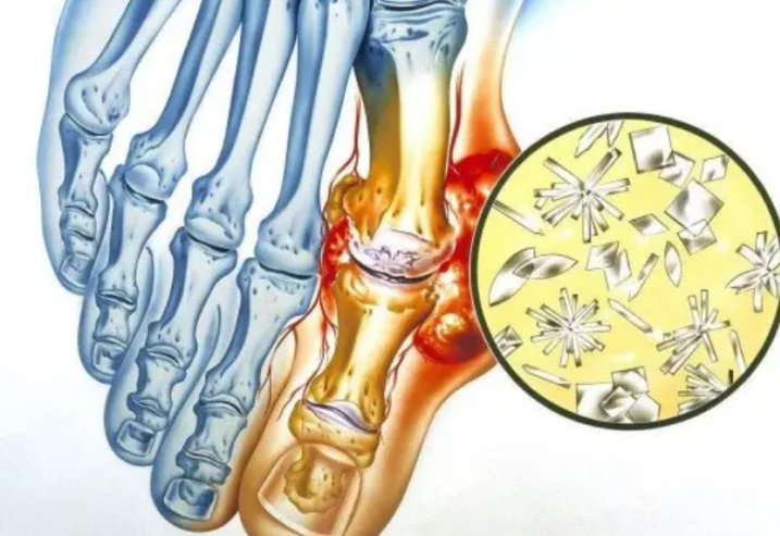 伤肾|多家医院联合呼吁：停食“1素菜”，比海鲜还伤“肾脏”，趁早忌口