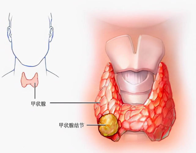 脂肪酸|我国超1/2人有甲状腺病？内分泌科权威专家：忌口“1黄1白”，比戒碘更管用