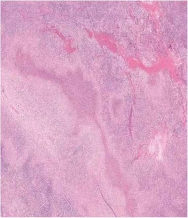 高血压|淋巴结肿大不要掉以轻心,也可能是肿瘤!