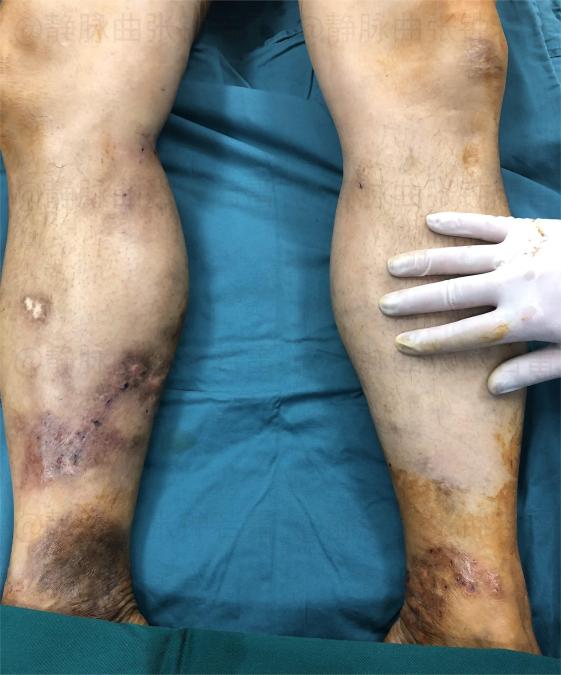 |【有问必答】老烂腿会导致小腿发麻吗