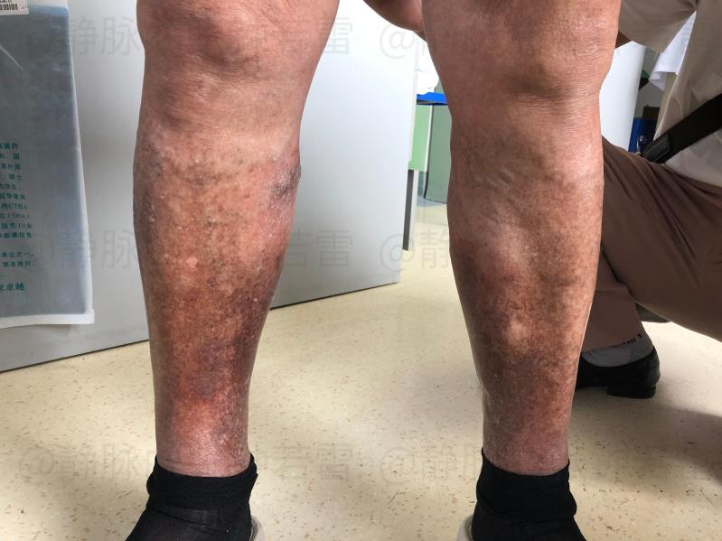 静脉曲张|【门诊纪实】中药泡脚、中医放血可以治愈下肢静脉曲张吗？