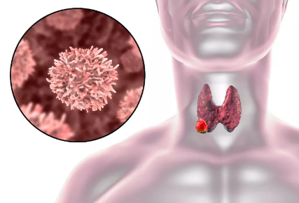 重金属|“睡觉”时有4种表现，说明你的甲功“很差”，趁早检查一下