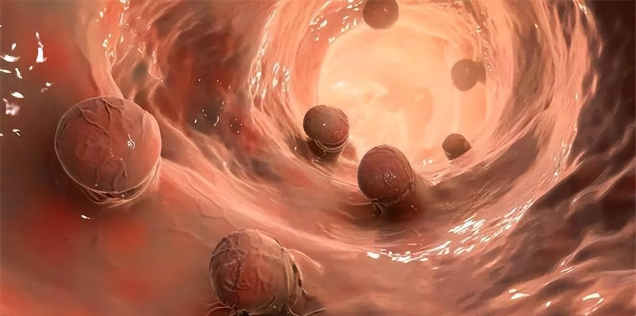 肠息肉|为什么肠道容易长“息肉”?肠内若有息肉,身体会有什么症状?