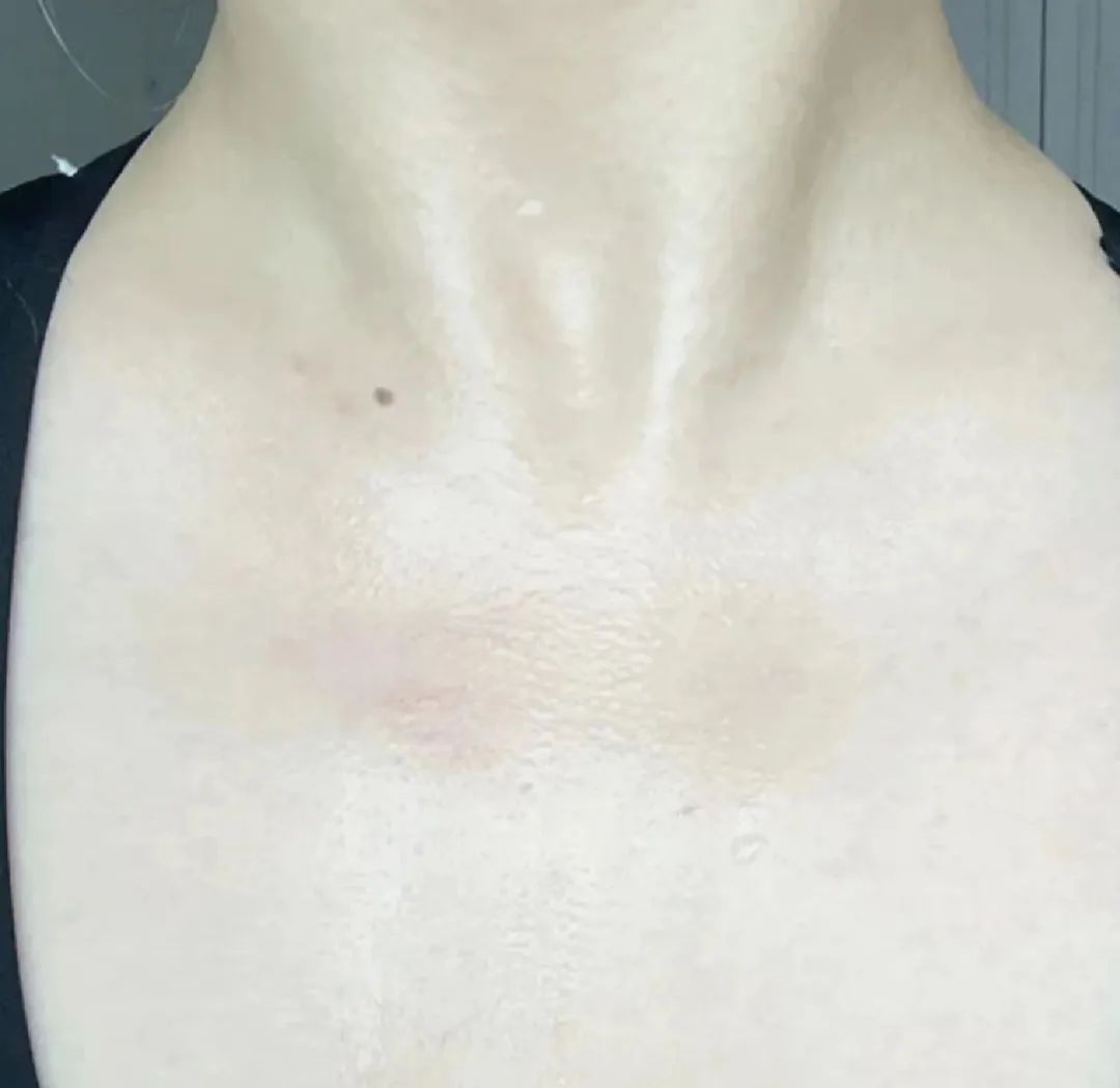 痘痘 全网公认3款口碑不俗的沐浴露，用完皮肤嫩滑不长痘！国货真靠谱！