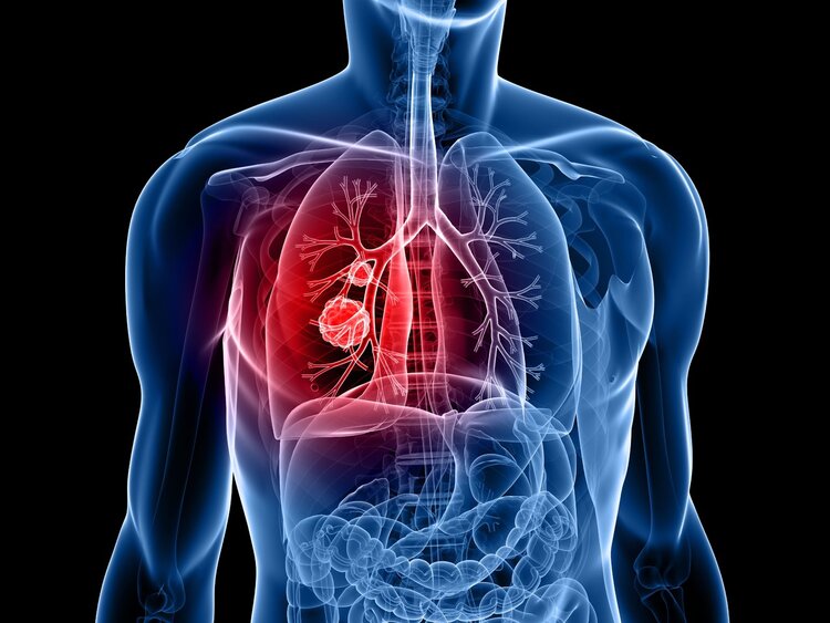 肺癌|肺癌来临总是“不声不响”？忠告：身体有这4种表现，尽早检查CT