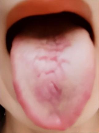 干吃不胖也是病？先健脾再滋阴！中医教你轻松长胖