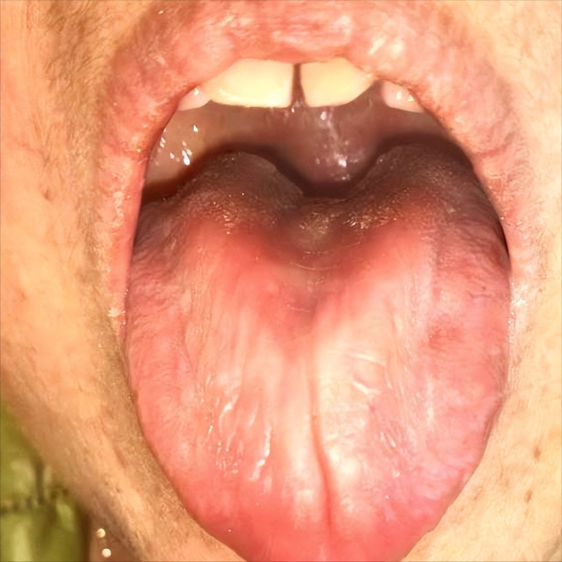 建议收藏——详细的舌象解析