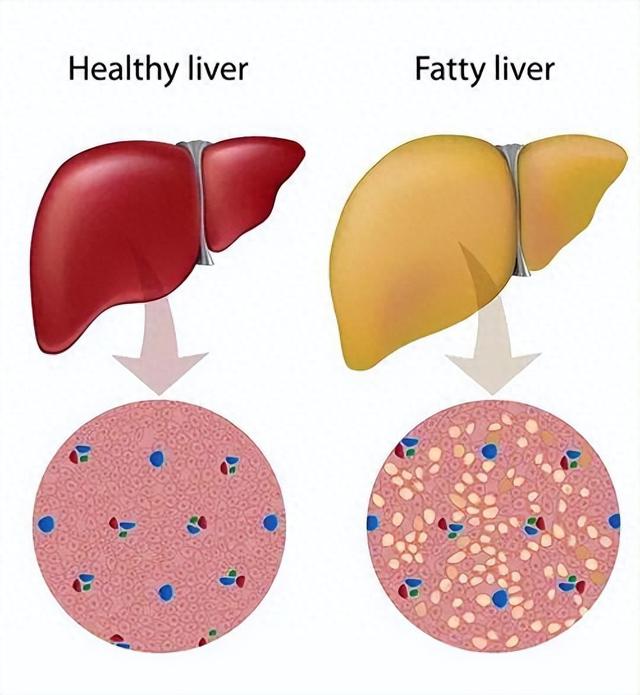 过度减肥也会脂肪肝？中医源头调理优势大