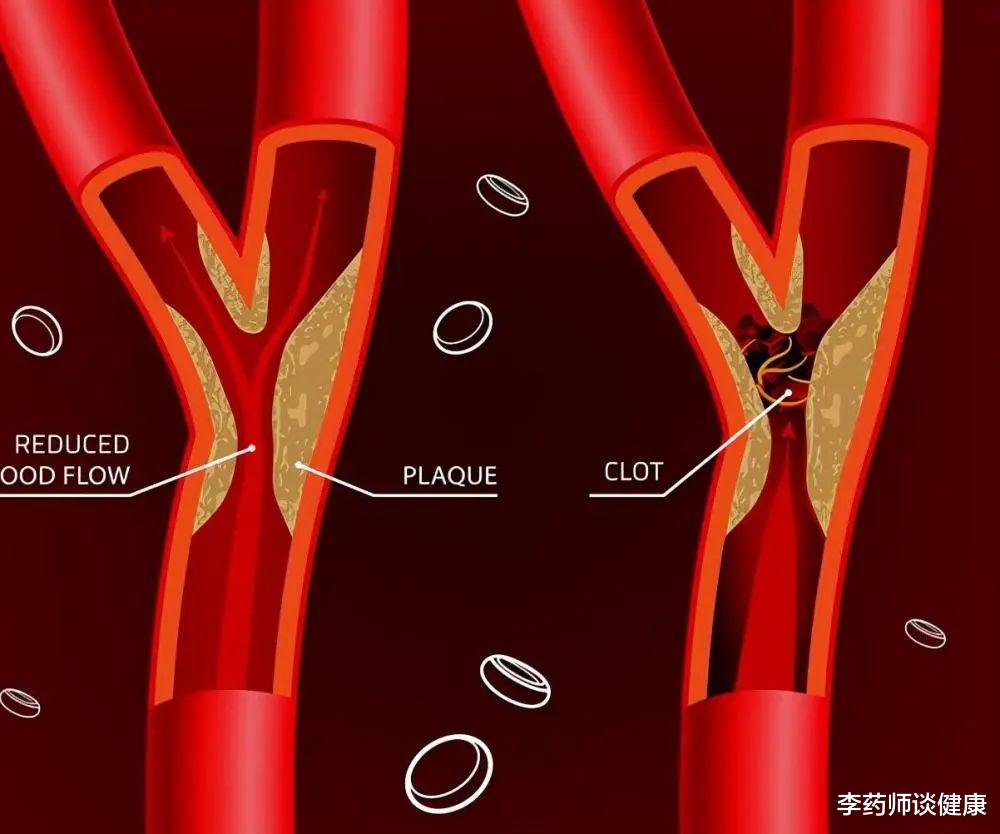 颈动脉发现斑块意味着什么？一定要吃他汀和阿司匹林吗？