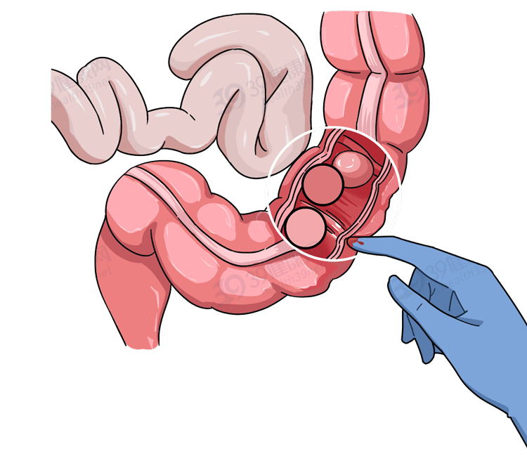 医生|为啥很多人不愿意做肠胃镜？提醒：发现早期癌症，5类人及时检查