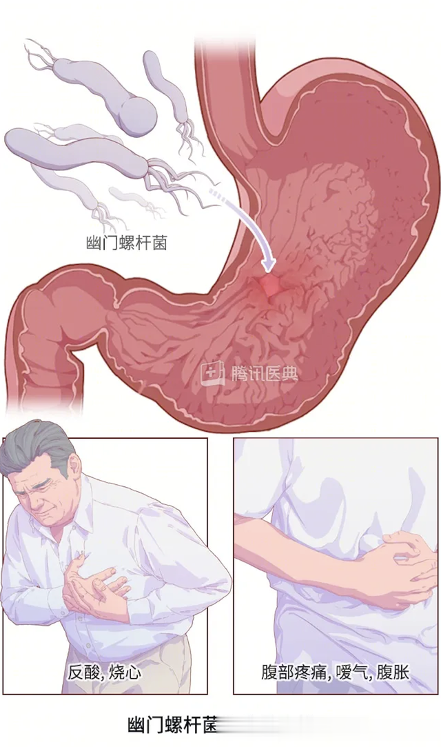 家人有幽门螺杆菌，一起吃饭会传染给孩子吗？