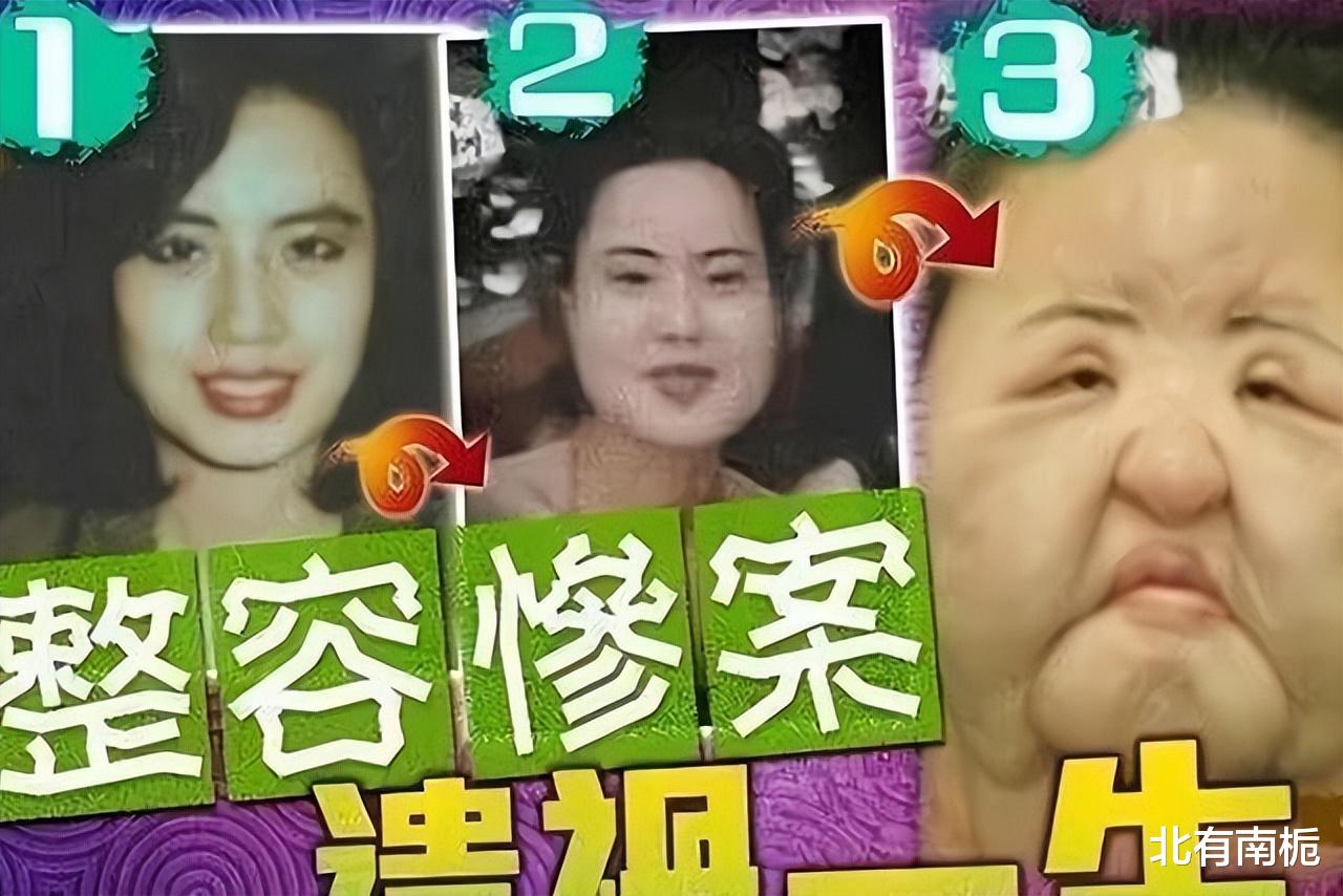 韩国女星整容上瘾注射大豆油,脸部取出8斤异物,最后孤独离世