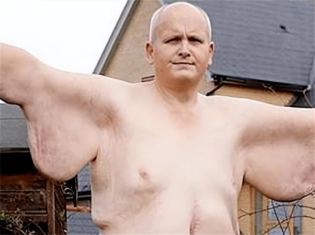 他体重曾达1016斤，喝毒药都被肥肉吸收，医生：死后得送去屠宰场