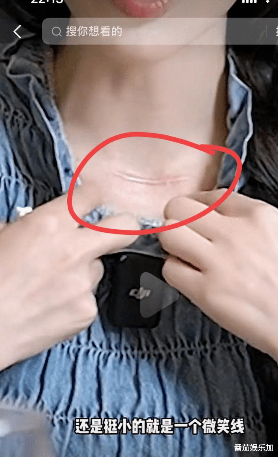 30岁冯提莫患甲状腺癌晚期,父母至今不知想要轻生,劝大家要小心