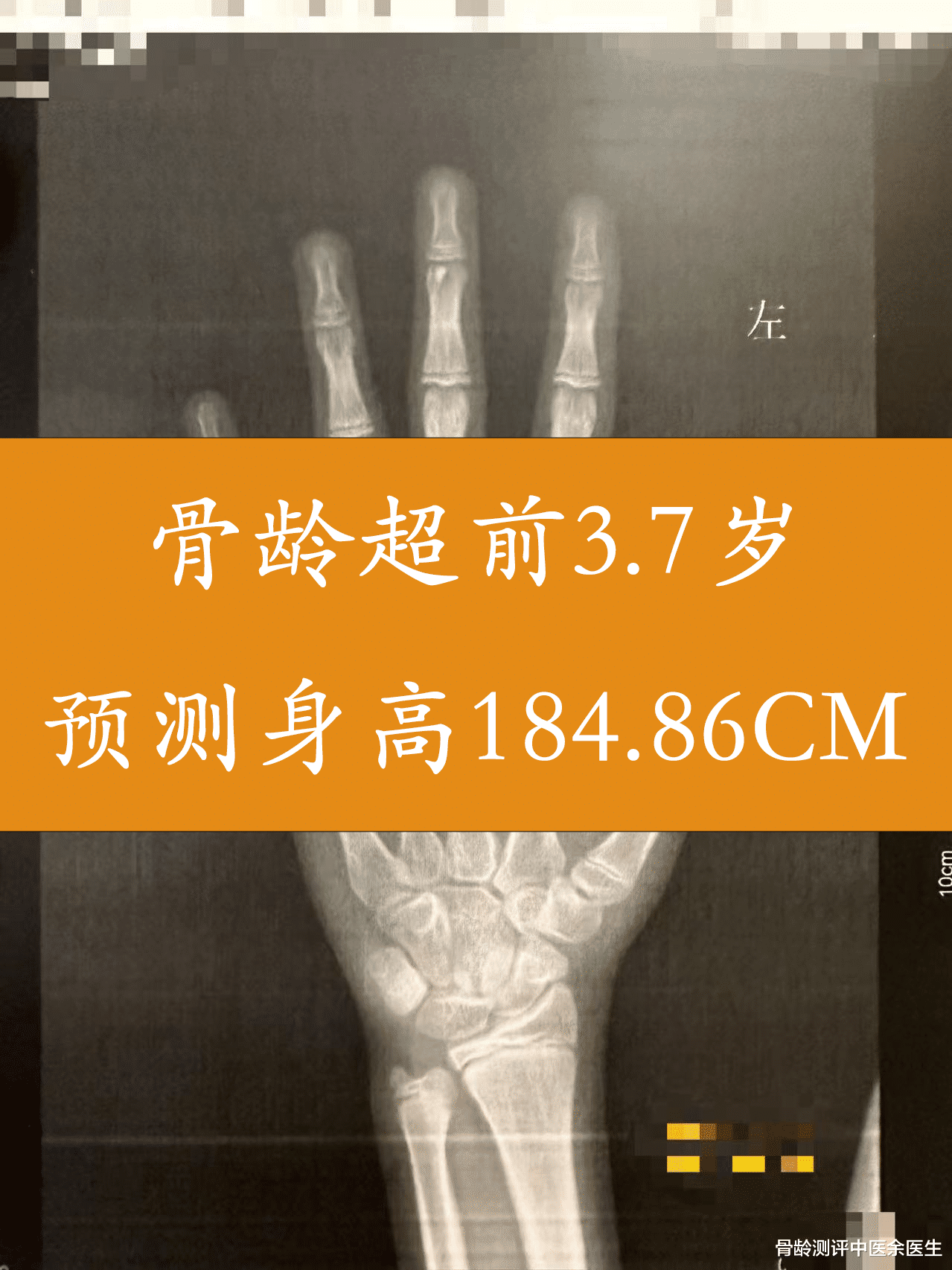 臀部|骨龄超前3.7岁，预测身高184.86cm