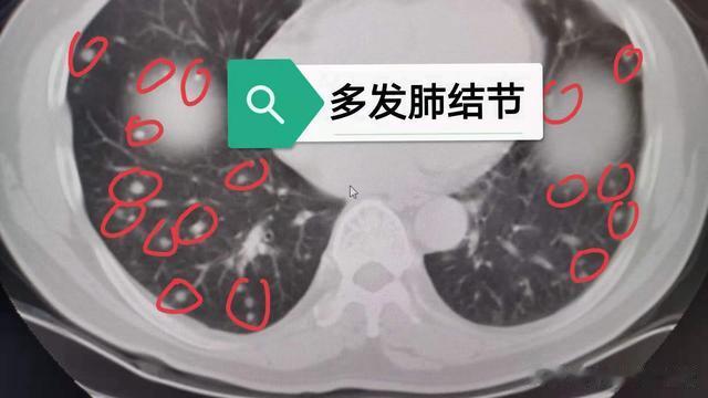 用一张方子解决肺结节后,我才明白:扼杀中医的就是中医自己!
