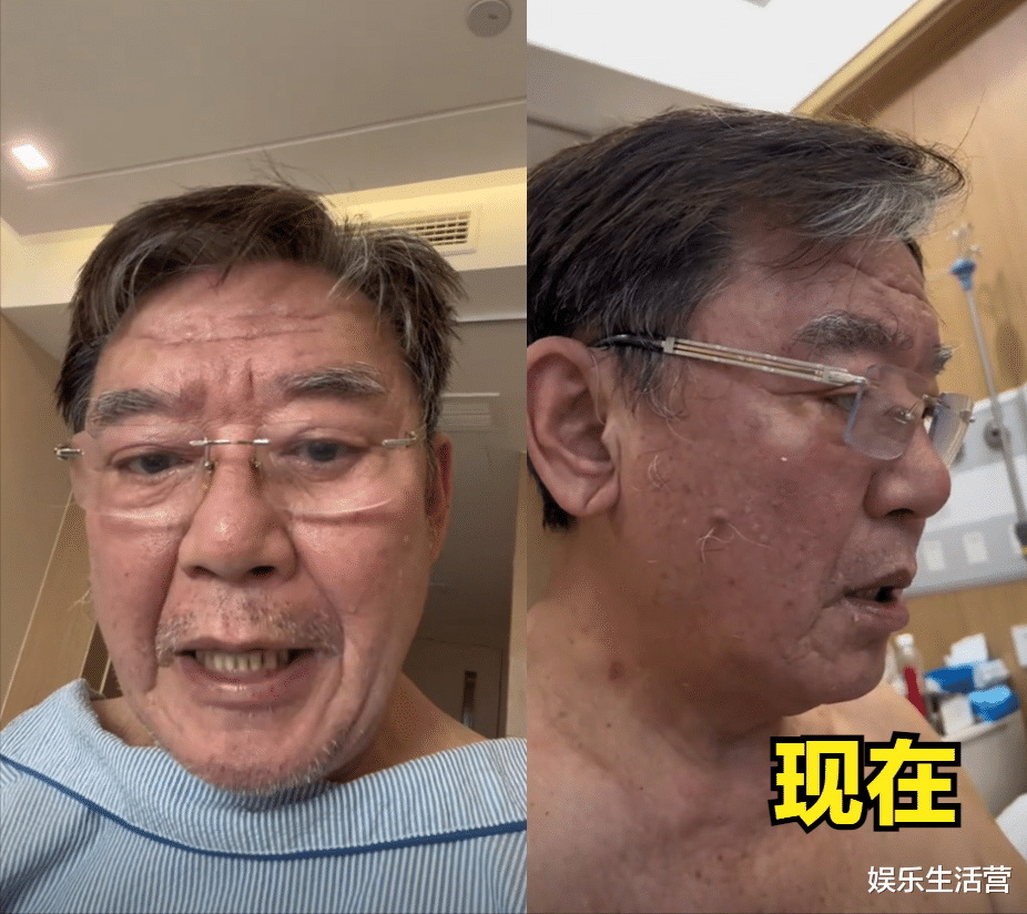 71岁李立群病情加重!对输液管说话,背长脓疱吃发物,网友:活该