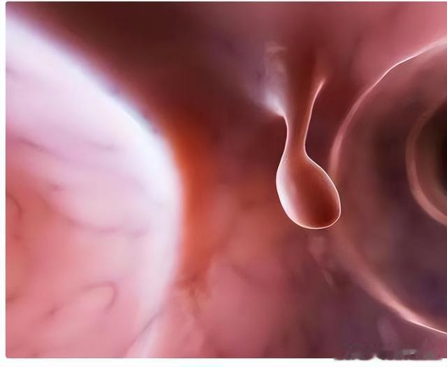 新型冠状肺炎|肠息肉不想变肠癌,医生提醒:3种东西尽量少吃,再馋也要忍住