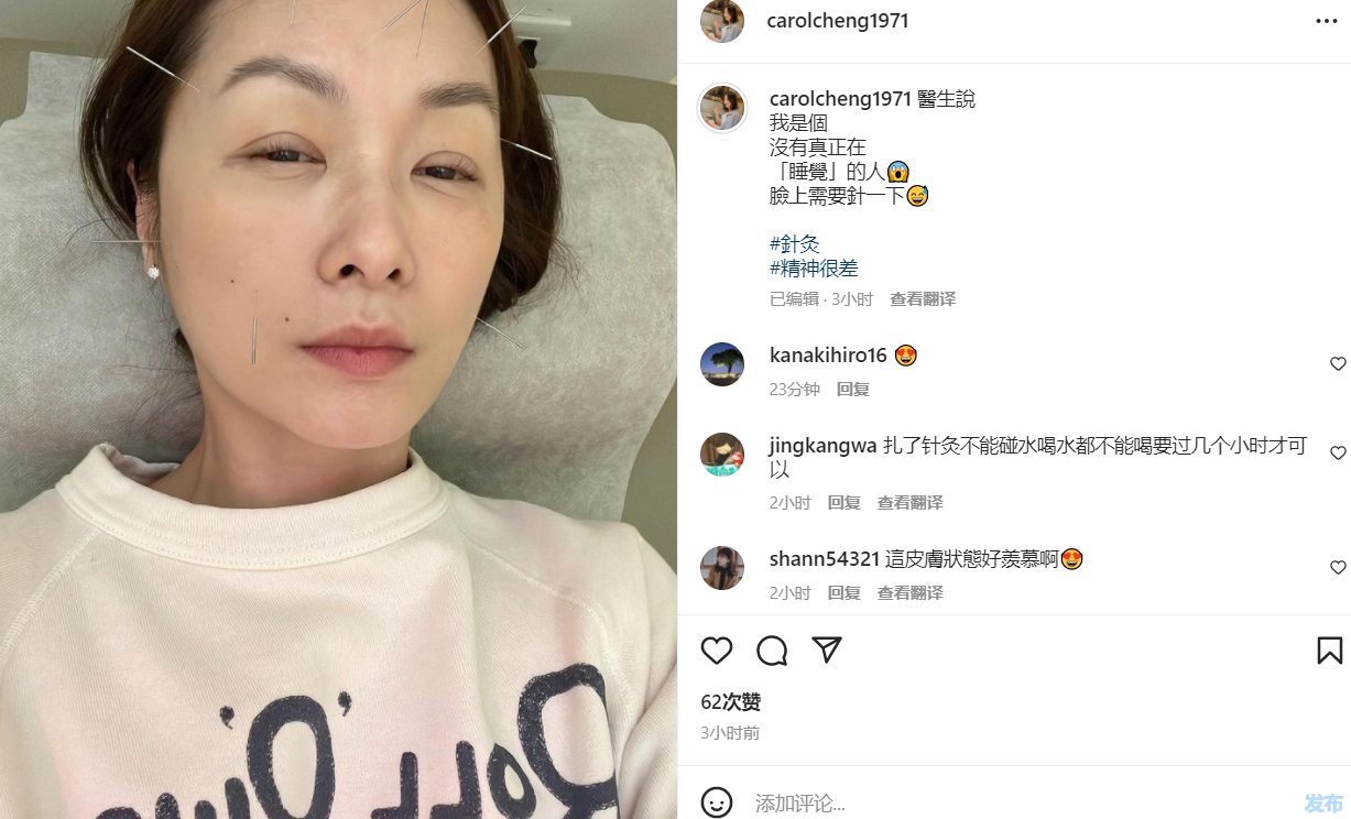 曾黎|郑家榆脸上扎满针,自曝精神很差!51岁仍未婚,羡慕别人结婚生娃!