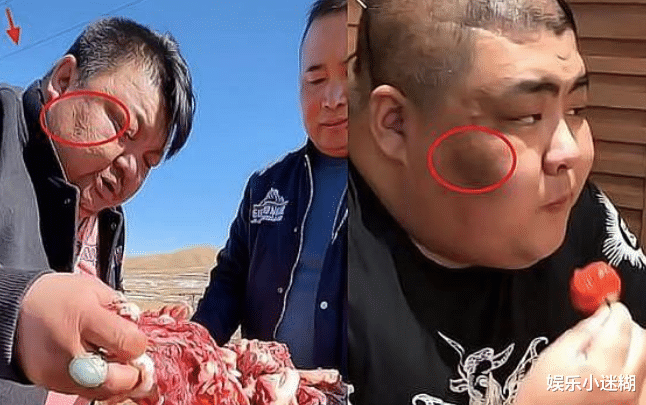 |网红恩克自曝4个月吃110只羊，面部黑斑加重、疣增多，健康引担忧