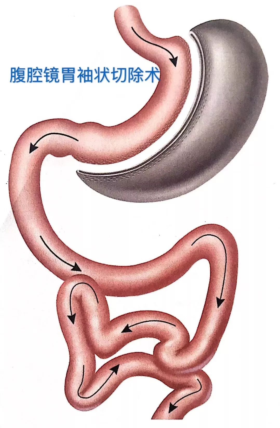 腹肌锻炼|什么样的人适合手术减肥？减肥手术有哪些优缺点？