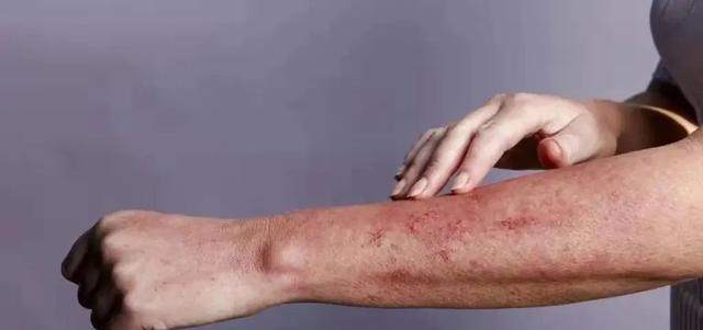 尿酸|女大学生反复口腔溃疡,各种用药治不好,真实病因让她崩溃