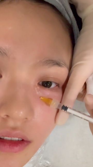 太真实!林允晒打水光针过程,画面高能,全程面不改色引争议