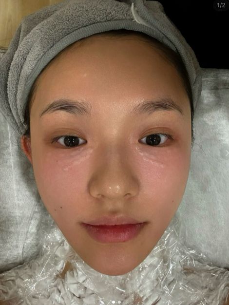 太真实!林允晒打水光针过程,画面高能,全程面不改色引争议