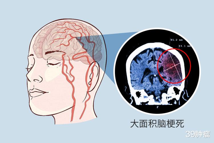 为何中国脑梗越来越多，美国却在减少？医生坦言：主要原因有4点