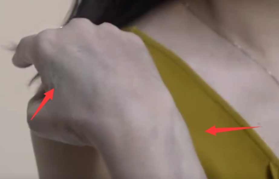 周海媚去世前最后写真曝光,手背大片淤青,面容憔悴显病态