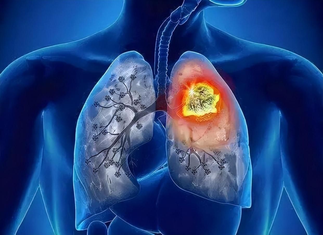 肺癌|肺部病变，“喉咙”先知？医生：若有3大异常，建议早做肺CT筛查