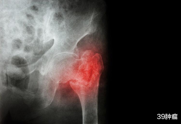 老人摔一跤就骨折?提醒:老人多补充2种营养,或降低14%髋部骨折