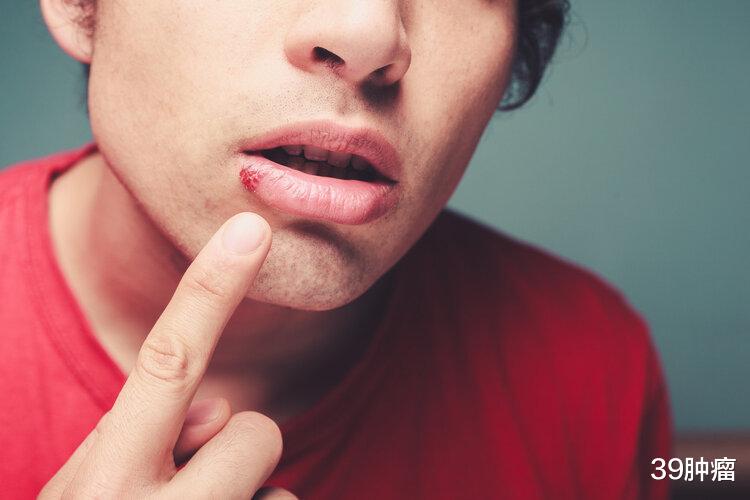 肺动脉高压|嘴唇颜色深,说明心血管不好?提醒:嘴唇出现3个变化,不算好事