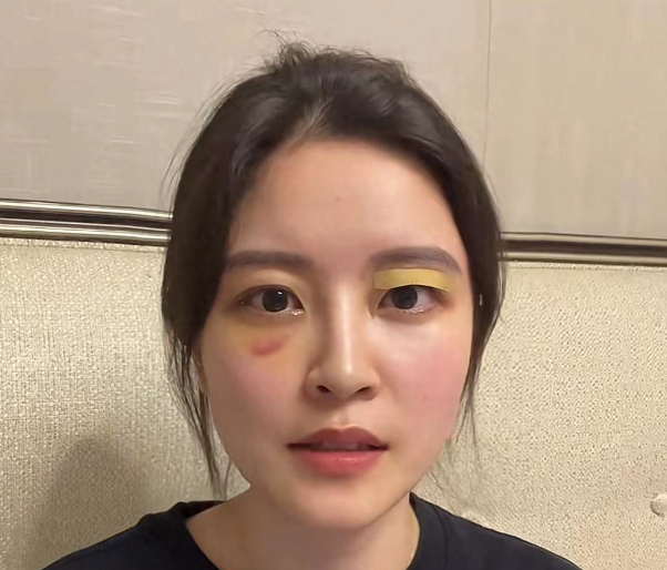 曝好声音学员发声后被打，鼻青脸肿申请警方保护，被扒疑是蹭流量