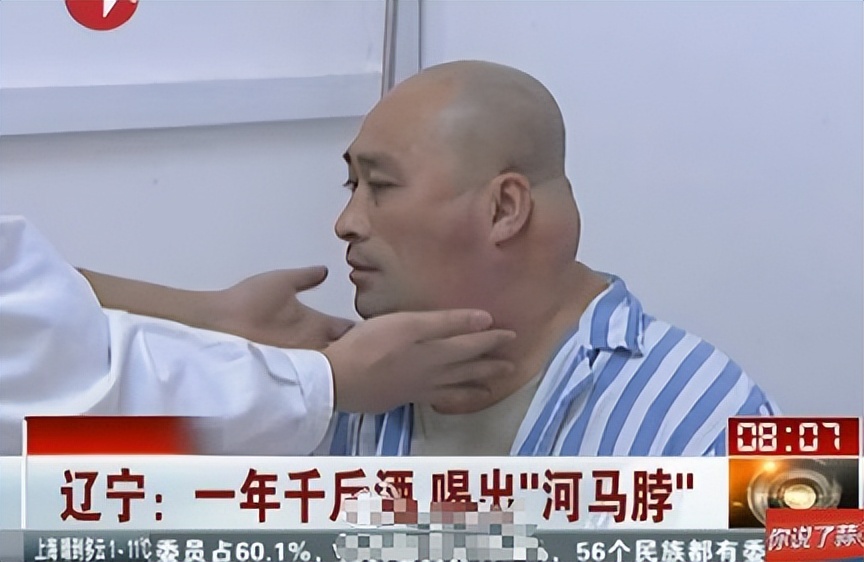 46岁男子20年喝了两万斤酒，脖子变成河马脖，总量至少有8700斤