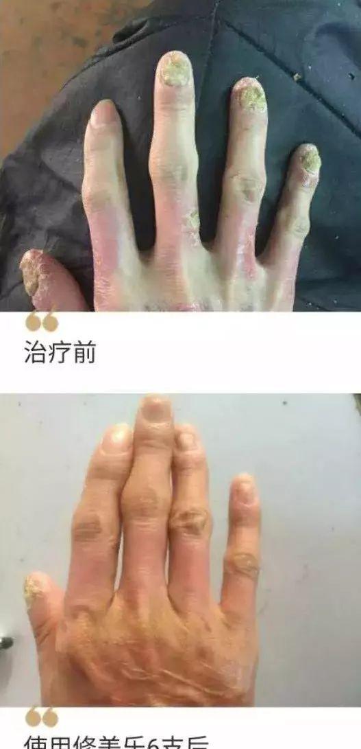 银屑病|银屑病指甲太受伤，病友群里秀指甲才发现很多被误诊