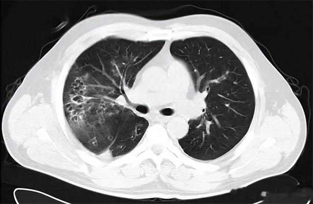 肺有病,喉先知!医生:当喉咙出现这几种情况,可能是肺出问题了