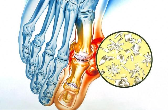 茄子是痛风的“发物”？医生：若想降尿酸，这3物要少吃